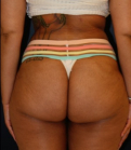 Feel Beautiful - Liposuction Back-Waist-Front 206 - After Photo